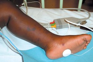 The leg of a person with black skin lying in a hospital bed. There is a darker rash visible on the side of the leg and foot. Image from NHS website.