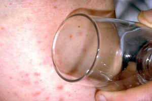 A close-up picture of white skin with a red blotchy rash. A glass is pressed firmly against the rash, but it is still visible through the glass. Image from NHS website.